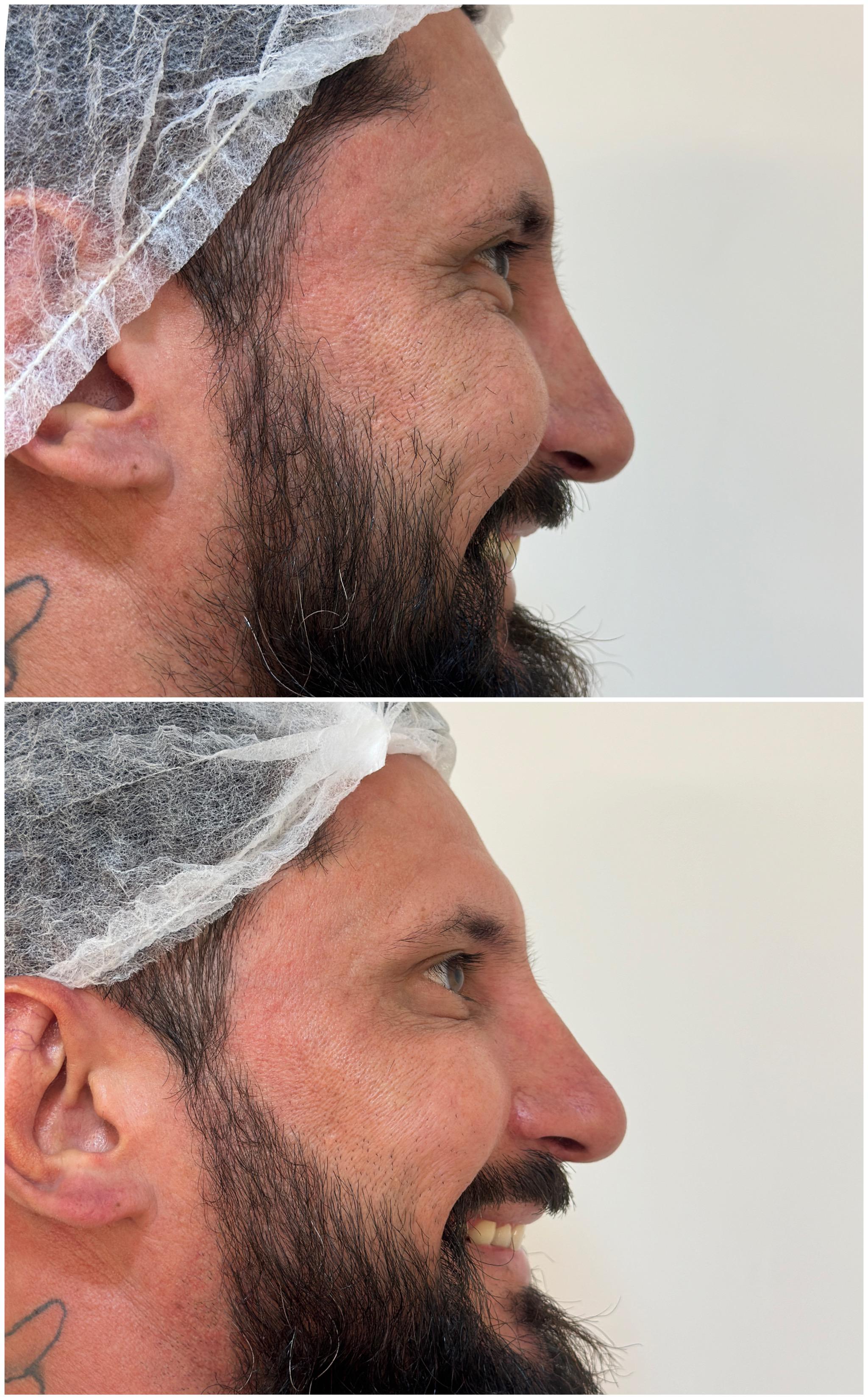 Antes e depois do botox masculino - redução de rugas faciais em paciente masculino
