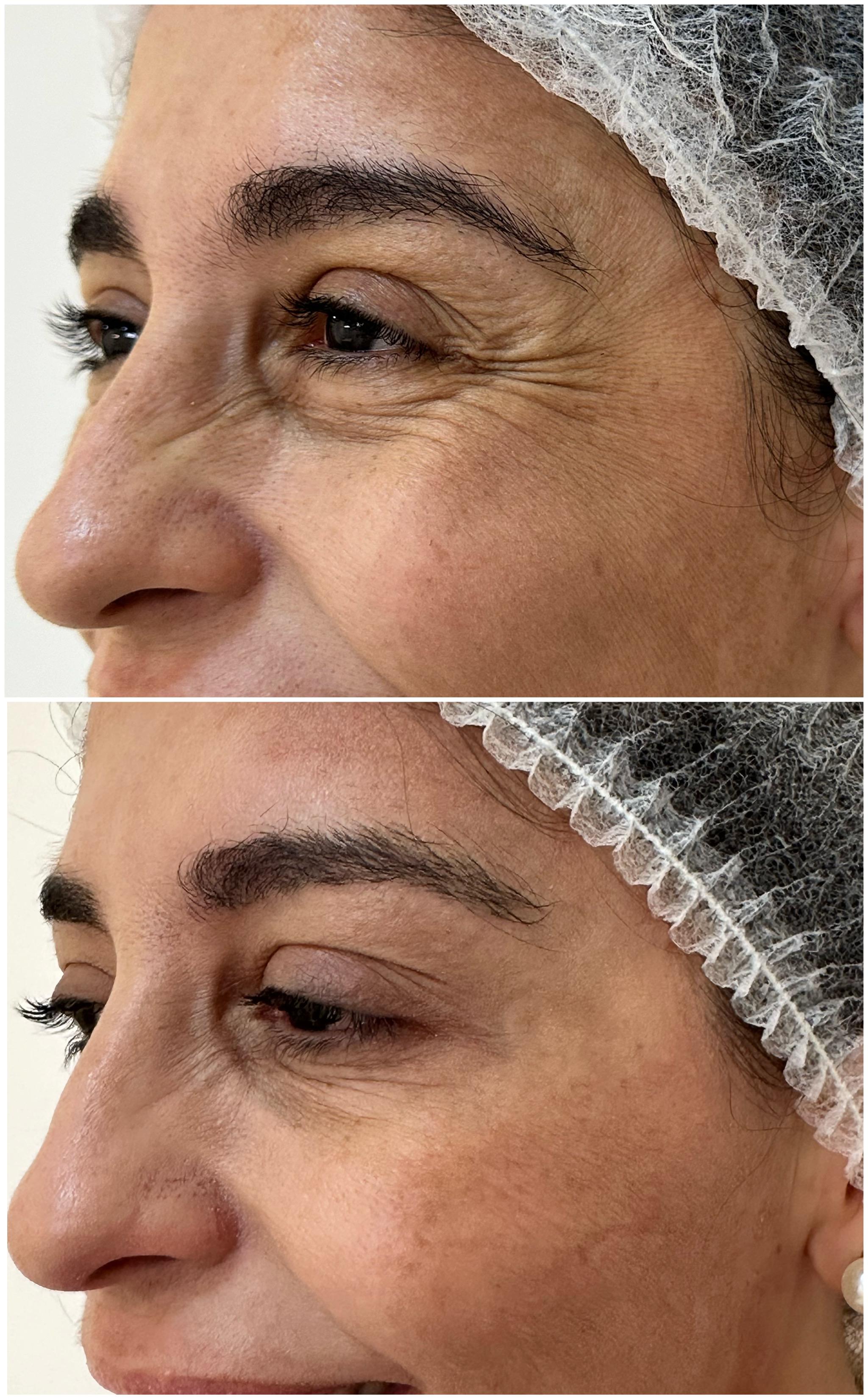 Antes e depois do botox para rugas - redução visível de linhas de expressão ao redor dos olhos