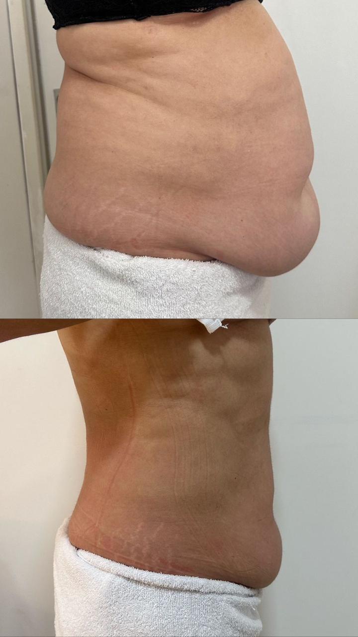 Antes e depois da criolipólise HB - redução significativa de gordura abdominal em paciente feminina