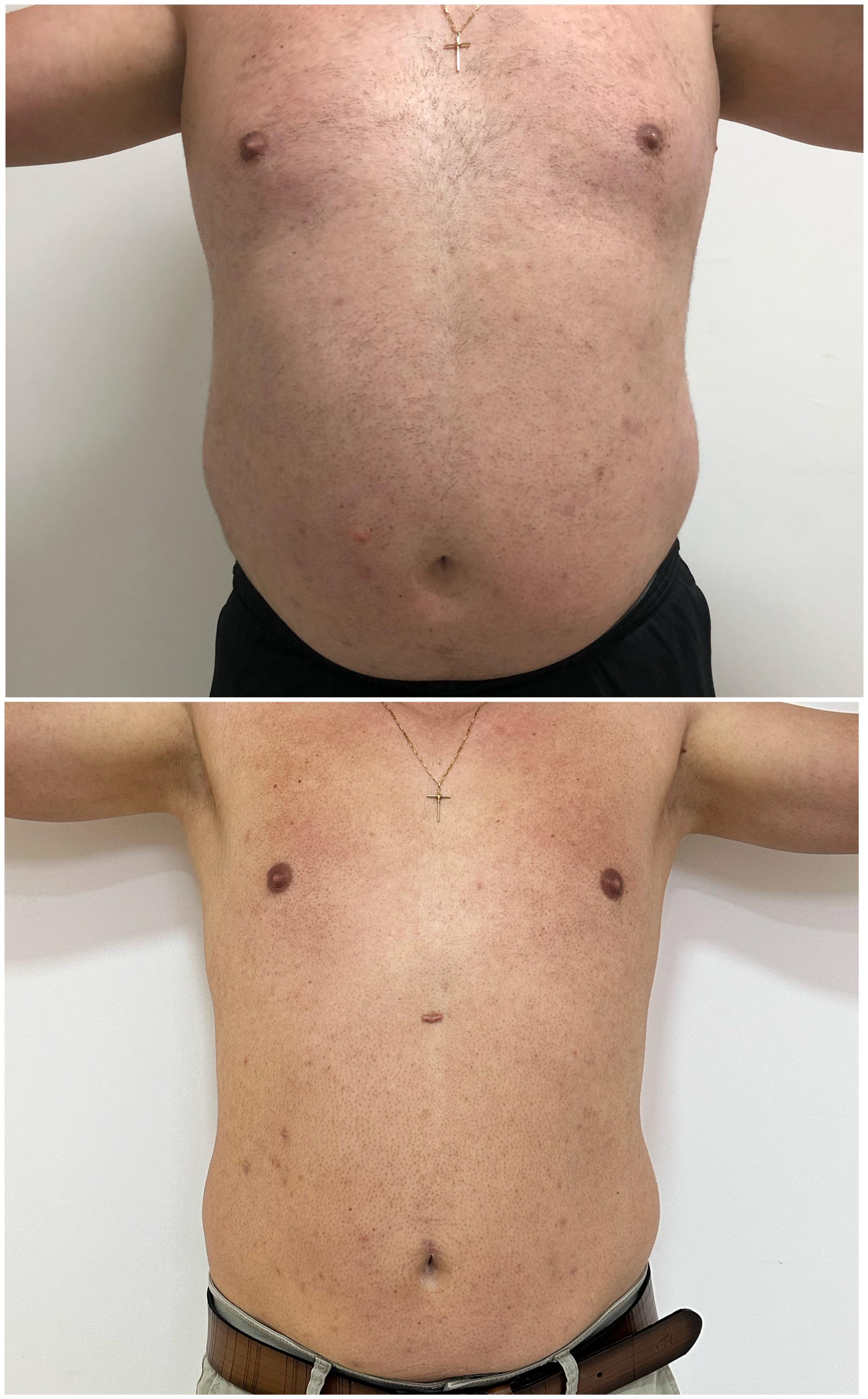 Antes e depois da criolipólise masculina - redução de gordura abdominal em paciente masculino