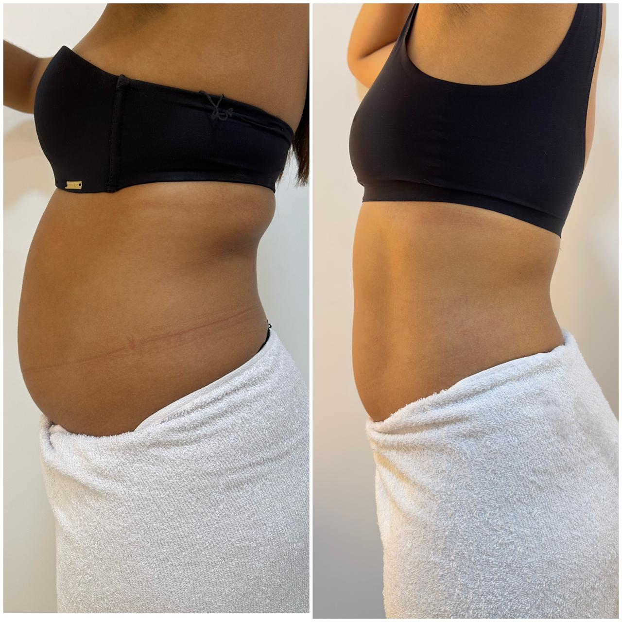 Antes e depois do tratamento de diástase HB - melhora significativa do contorno abdominal