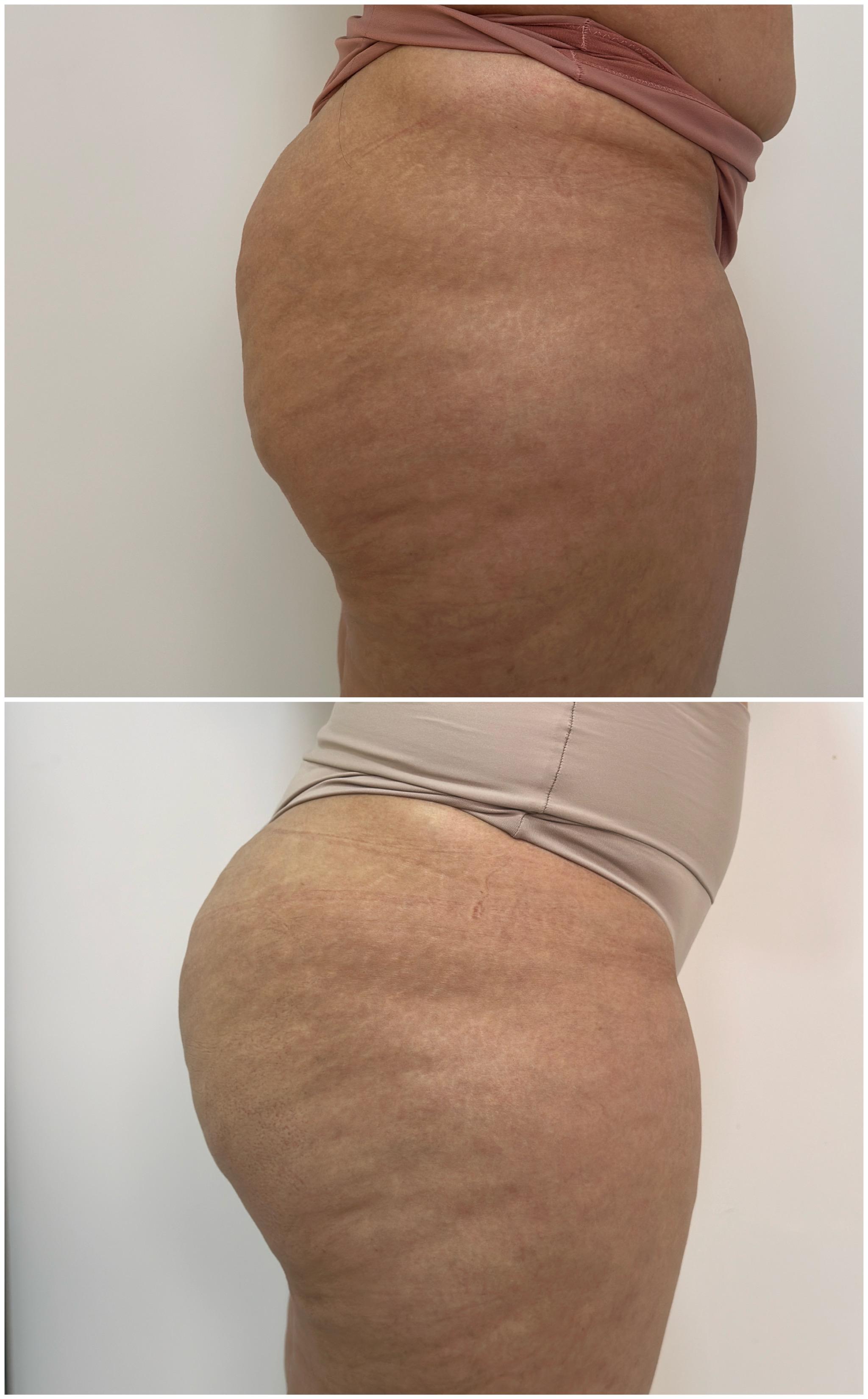 Antes e depois do Glúteo UP - levantamento não-cirúrgico dos glúteos