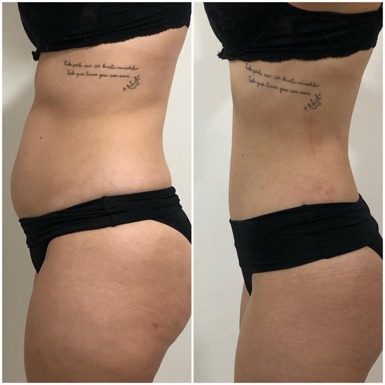Antes e depois da lipoenzimática - redução de medidas na cintura e contorno corporal