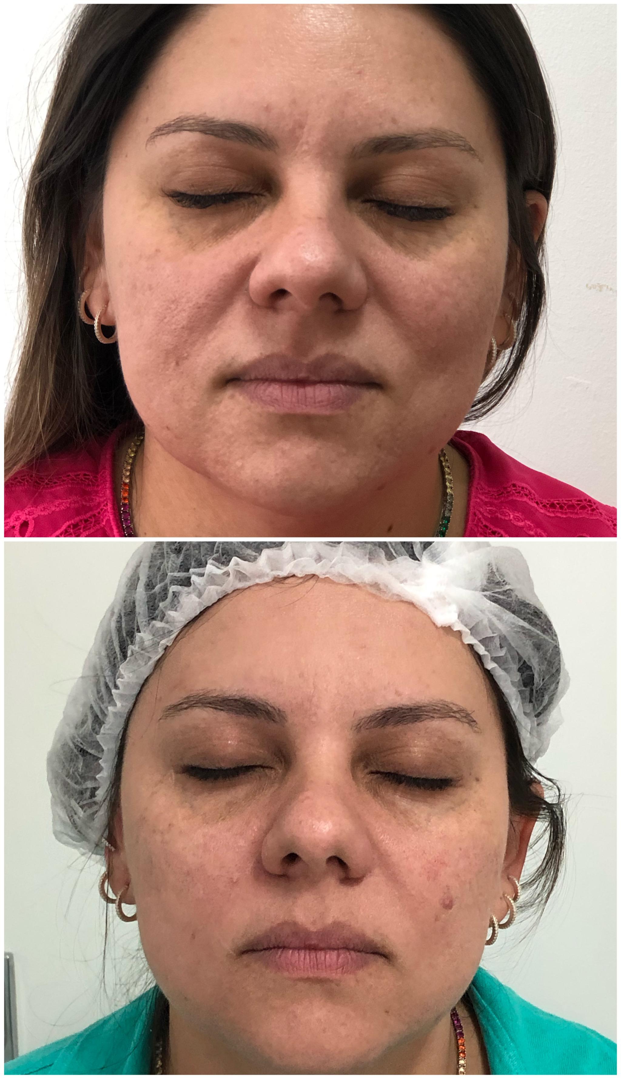Antes e depois da harmonização facial MD Codes - rejuvenescimento e contorno facial