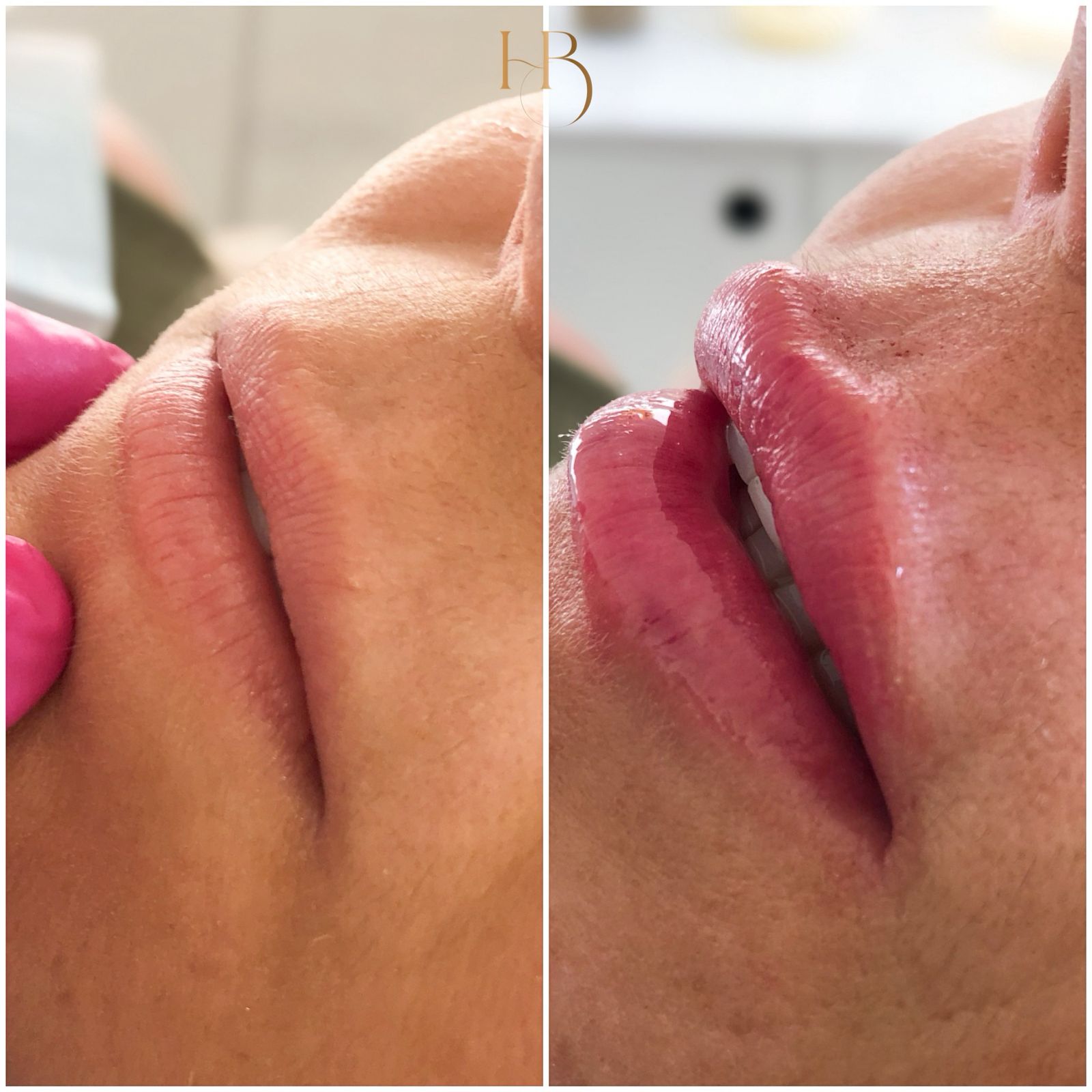 Antes e depois do preenchimento labial - aumento natural e harmonioso dos lábios