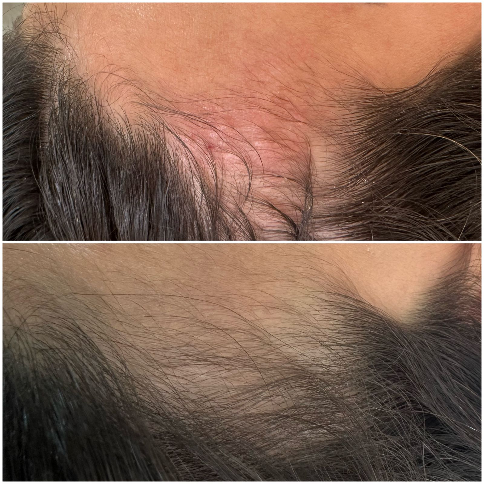Antes e depois do tratamento capilar - crescimento capilar em área de calvície masculina